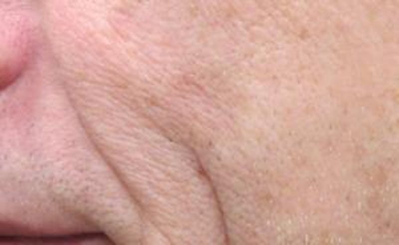 Red/Brown Spot Removal Before & After Gallery - Patient 140129 - Image 2