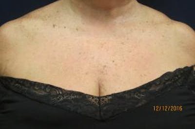 Red/Brown Spot Removal Before & After Gallery - Patient 140100 - Image 1