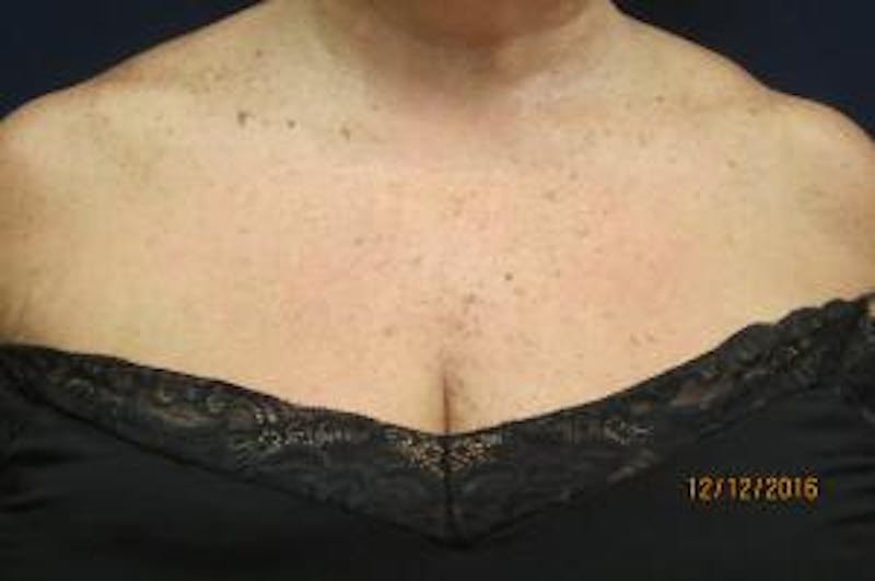 Red/Brown Spot Removal Before & After Gallery - Patient 140100 - Image 1