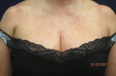 Red/Brown Spot Removal Before & After Gallery - Patient 140100 - Image 2