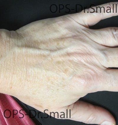 Red/Brown Spot Removal Before & After Gallery - Patient 183227 - Image 1
