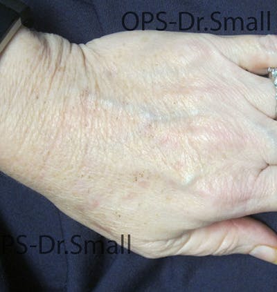 Red/Brown Spot Removal Before & After Gallery - Patient 183227 - Image 2