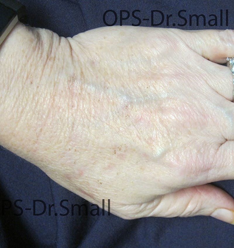 Red/Brown Spot Removal Before & After Gallery - Patient 183227 - Image 2