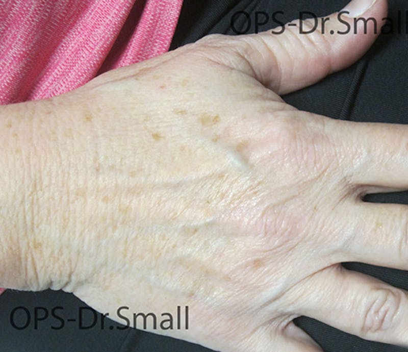 Red/Brown Spot Removal Before & After Gallery - Patient 183227 - Image 3