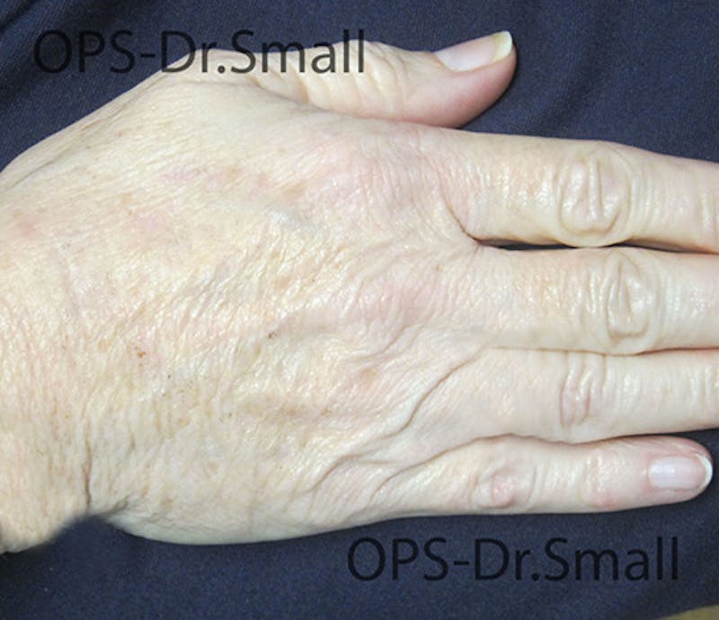 Red/Brown Spot Removal Before & After Gallery - Patient 183227 - Image 4
