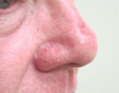 Red/Brown Spot Removal Before & After Gallery - Patient 141827 - Image 2