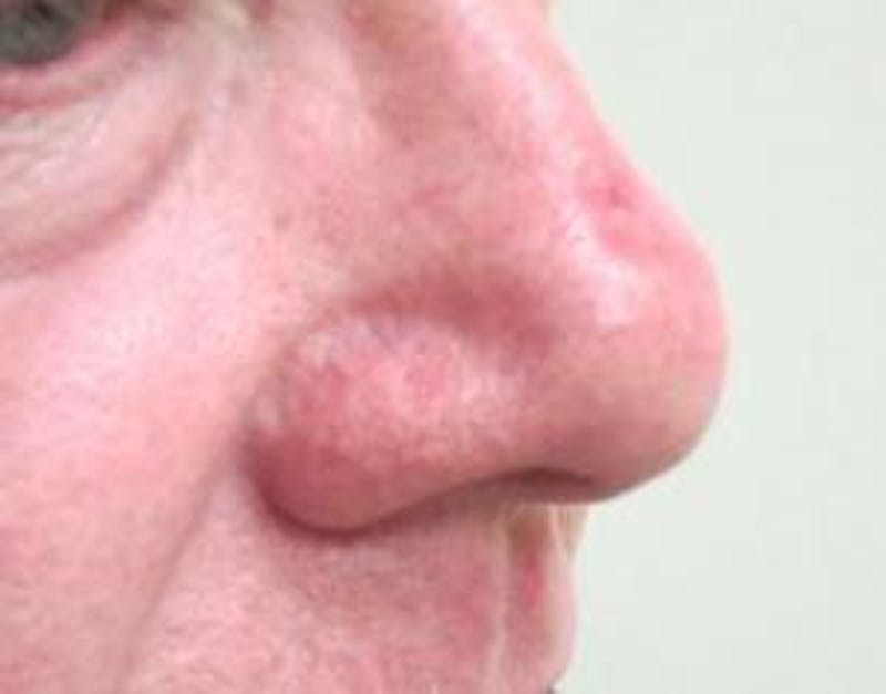 Red/Brown Spot Removal Before & After Gallery - Patient 141827 - Image 2