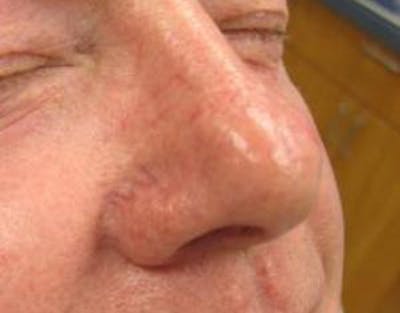 Red/Brown Spot Removal Before & After Gallery - Patient 141827 - Image 1