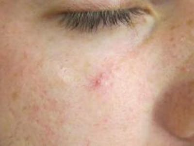 Red/Brown Spot Removal Before & After Gallery - Patient 131999 - Image 1