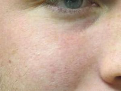 Red/Brown Spot Removal Before & After Gallery - Patient 131999 - Image 2