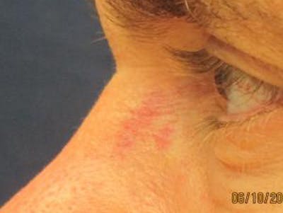 Red/Brown Spot Removal Before & After Gallery - Patient 127388 - Image 1