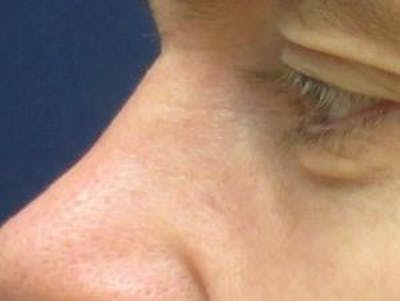 Red/Brown Spot Removal Before & After Gallery - Patient 127388 - Image 2