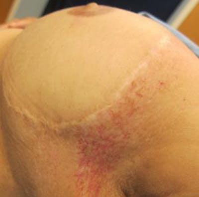Red/Brown Spot Removal Before & After Gallery - Patient 173677 - Image 1