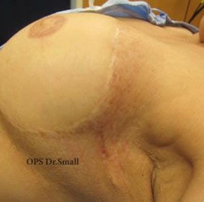 Red/Brown Spot Removal Before & After Gallery - Patient 173677 - Image 2