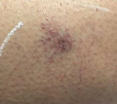 Spider Vein Treatment Before & After Gallery - Patient 422342 - Image 1