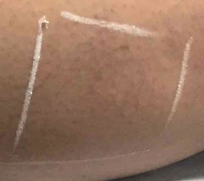 Spider Vein Treatment Before & After Gallery - Patient 422342 - Image 2