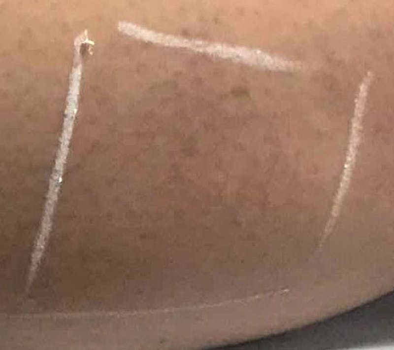 Spider Vein Treatment Before & After Gallery - Patient 422342 - Image 2