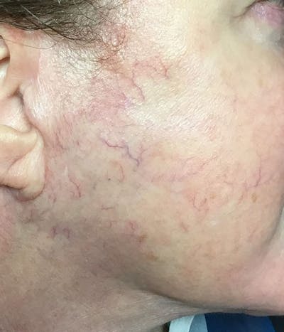 Spider Vein Treatment Before & After Gallery - Patient 251985 - Image 1