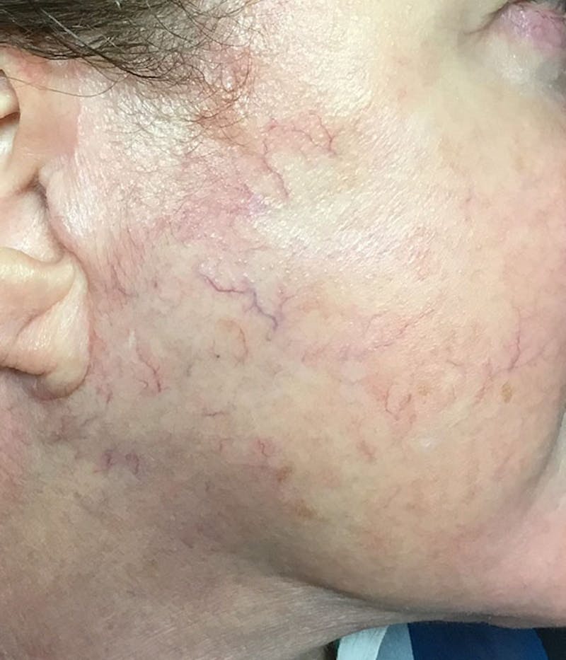Spider Vein Treatment Before & After Gallery - Patient 251985 - Image 1