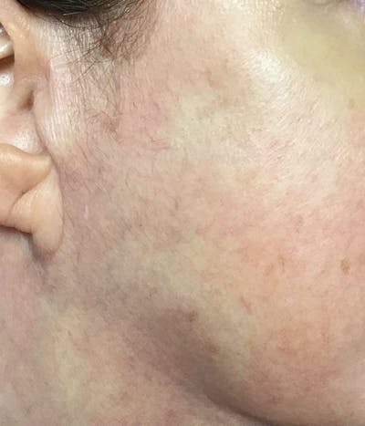 Spider Vein Treatment Before & After Gallery - Patient 251985 - Image 2