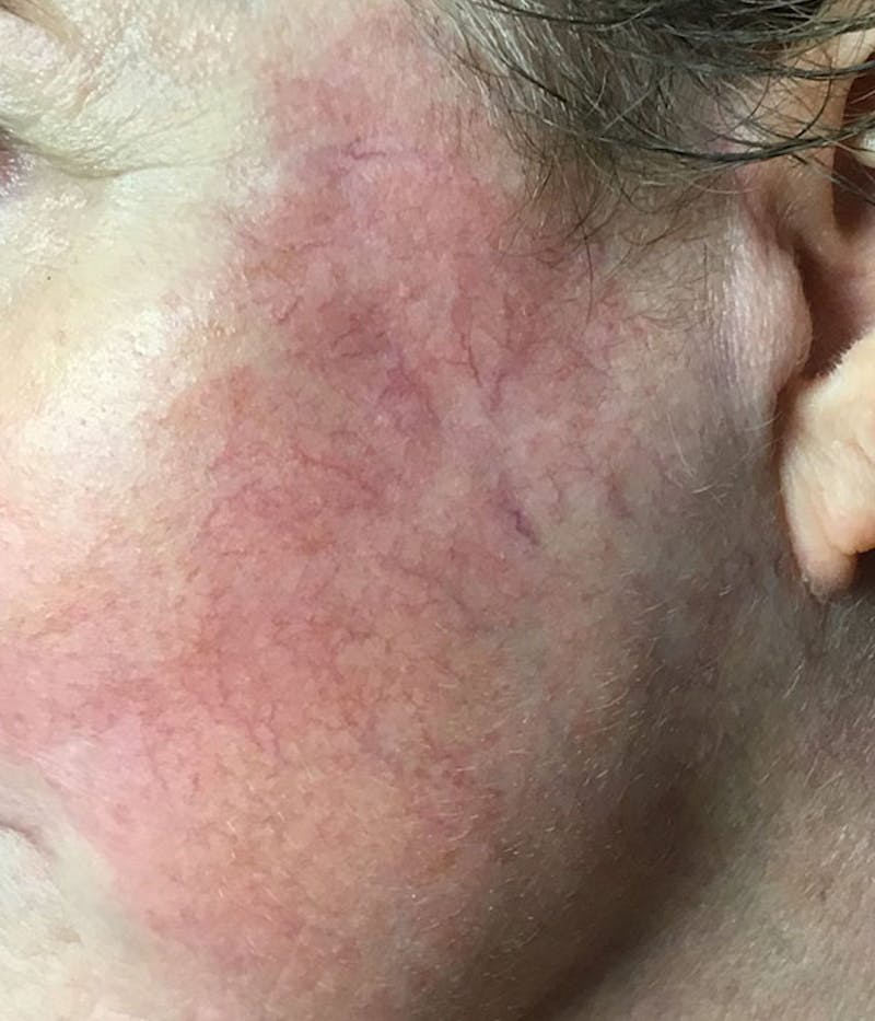 Spider Vein Treatment Before & After Gallery - Patient 251985 - Image 3