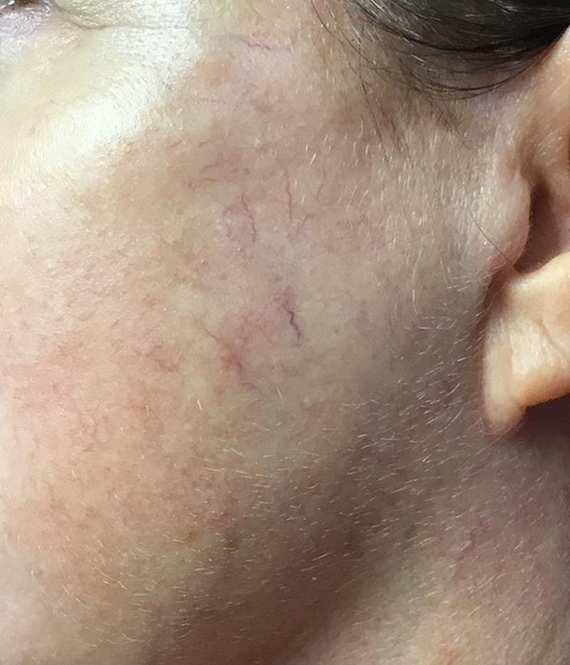 Spider Vein Treatment Before & After Gallery - Patient 251985 - Image 4