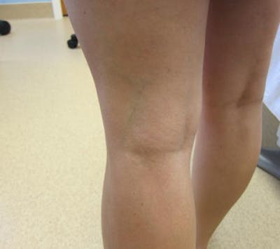 Spider Vein Treatment Before & After Gallery - Patient 216173 - Image 1