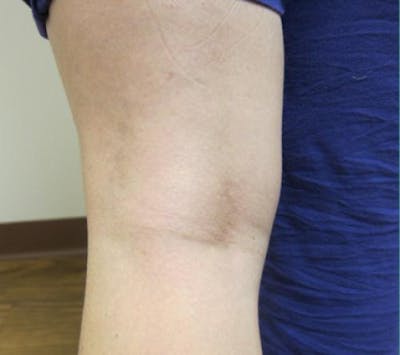 Spider Vein Treatment Before & After Gallery - Patient 216173 - Image 2