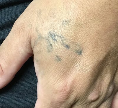 Tattoo Removal Before & After Gallery - Patient 154351 - Image 1