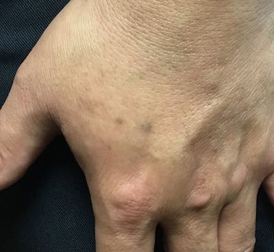 Tattoo Removal Before & After Gallery - Patient 154351 - Image 2