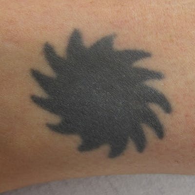 Tattoo Removal Before & After Gallery - Patient 787807 - Image 1