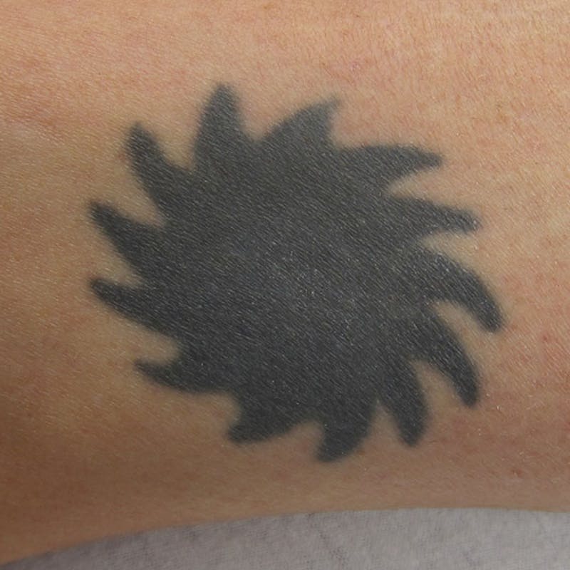 Tattoo Removal Before & After Gallery - Patient 787807 - Image 1