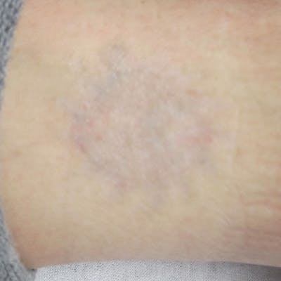 Tattoo Removal Before & After Gallery - Patient 787807 - Image 2