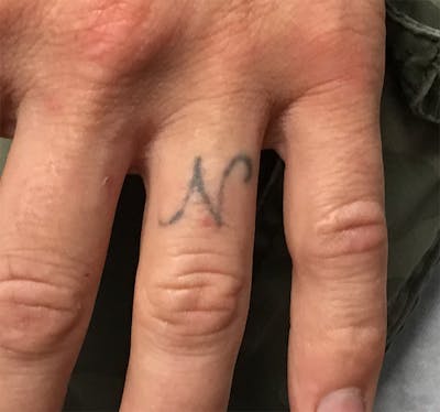 Tattoo Removal Before & After Gallery - Patient 640344 - Image 1
