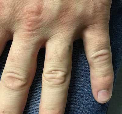 Tattoo Removal Before & After Gallery - Patient 640344 - Image 2