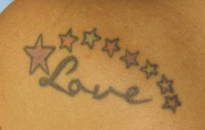 Tattoo Removal Before & After Gallery - Patient 108769 - Image 1