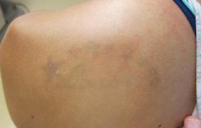Tattoo Removal Before & After Gallery - Patient 108769 - Image 2