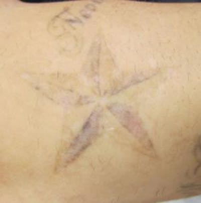Tattoo Removal Before & After Gallery - Patient 100362 - Image 1
