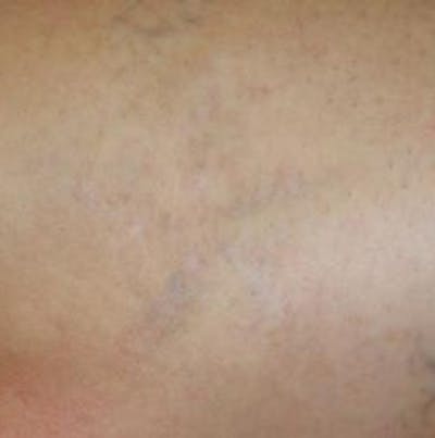 Tattoo Removal Before & After Gallery - Patient 100362 - Image 2
