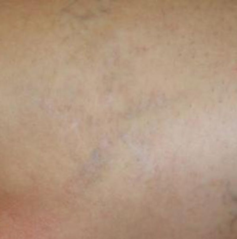 Tattoo Removal Before & After Gallery - Patient 100362 - Image 2