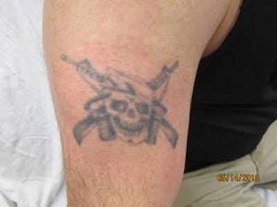 Tattoo Removal Before & After Gallery - Patient 281365 - Image 1