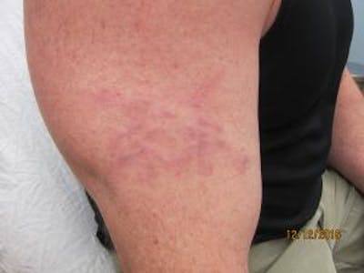 Tattoo Removal Before & After Gallery - Patient 281365 - Image 2
