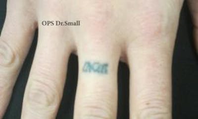 Tattoo Removal Before & After Gallery - Patient 267645 - Image 1