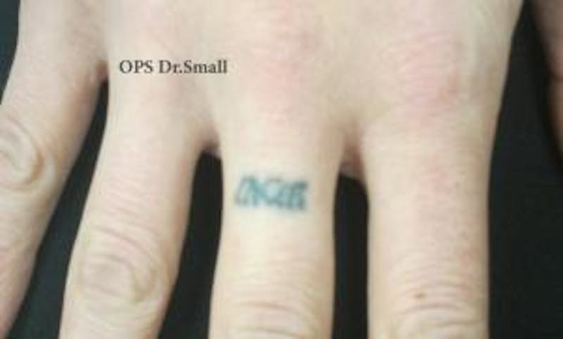 Tattoo Removal Before & After Gallery - Patient 267645 - Image 1