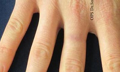 Tattoo Removal Before & After Gallery - Patient 267645 - Image 2