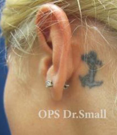 Tattoo Removal Before & After Gallery - Patient 346521 - Image 1