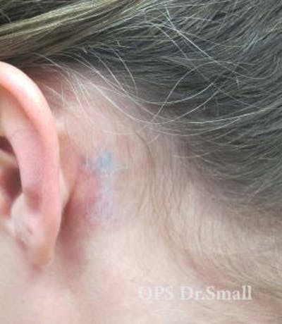 Tattoo Removal Before & After Gallery - Patient 346521 - Image 2