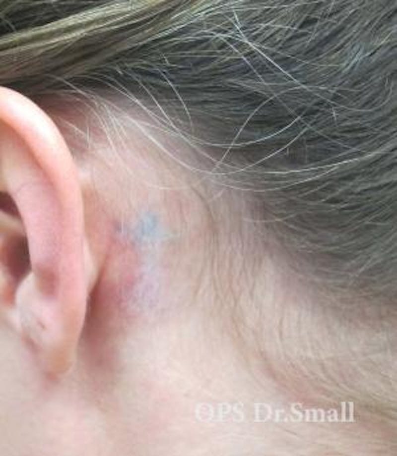 Tattoo Removal Before & After Gallery - Patient 346521 - Image 2
