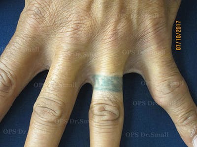 Tattoo Removal Before & After Gallery - Patient 377894 - Image 1
