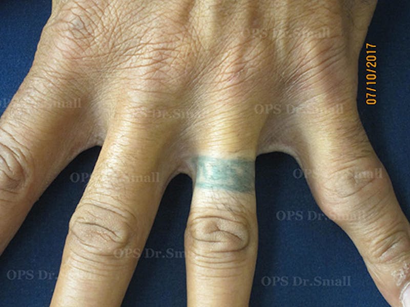 Tattoo Removal Before & After Gallery - Patient 377894 - Image 1